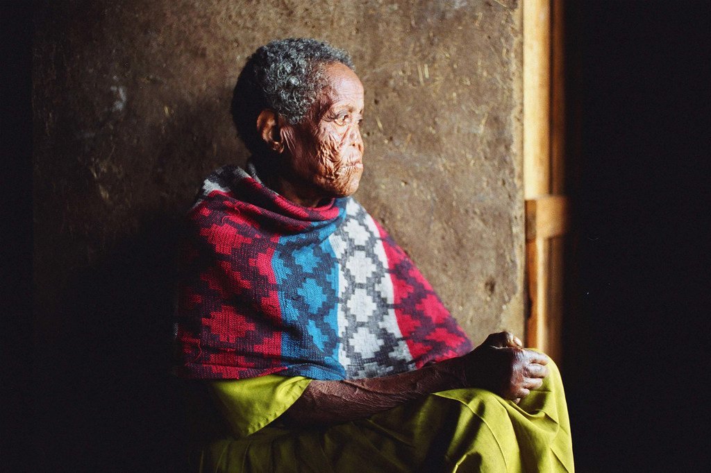 埃塞俄比亚首都亚的斯亚贝巴的一名麻风患者。